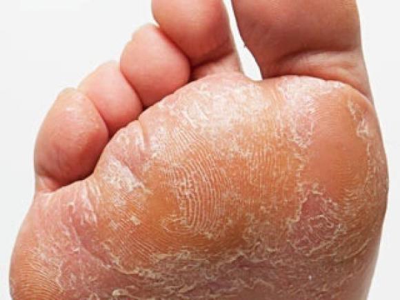 Kako sam riješio grozotu sa gljivicama