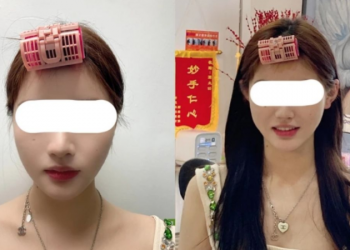 ‘Klempave’ uši novi su bizarni trend u Kini – sve više ljudi se operira kako bi ih imalo!