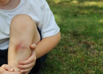 Na tijelu vam se pojavljuju iznenadne modrice? Evo zašto je tako