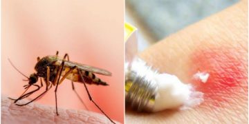 Imunolog je otkrio učinkovito sredstvo u borbi protiv svrbeža nakon uboda komaraca