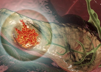 Prijelomno otkriće u liječenju najsmrtonosnijeg raka: Gremlin terapija može sve preokrenuti!