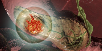 Prijelomno otkriće u liječenju najsmrtonosnijeg raka: Gremlin terapija može sve preokrenuti!