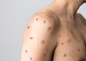 U Hrvatskoj potvrđen prvi slučaj majmunskih boginja