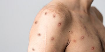 U Hrvatskoj potvrđen prvi slučaj majmunskih boginja