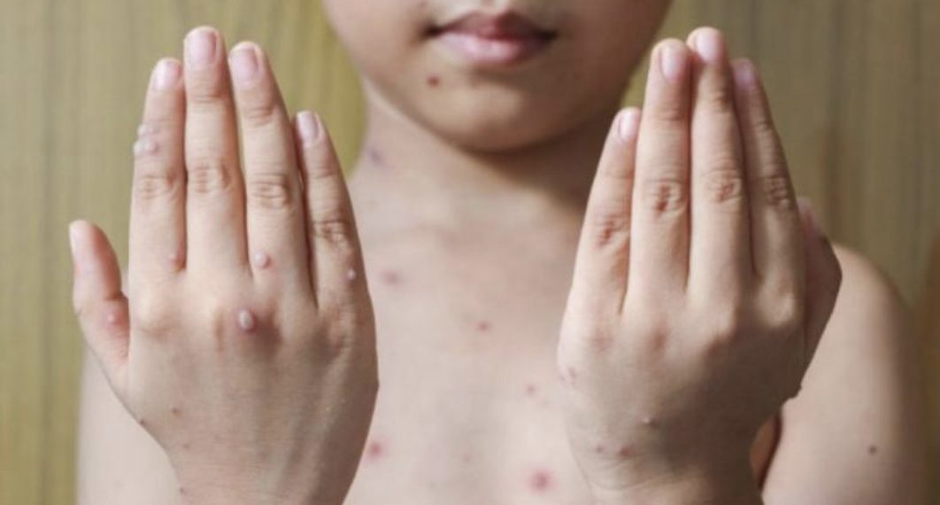 WHO objavio liste zemlje s najvećim brojem slučajeva majmunskih boginja u svijetu