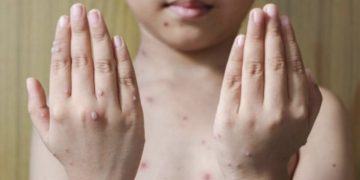 WHO objavio liste zemlje s najvećim brojem slučajeva majmunskih boginja u svijetu