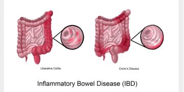Znanstvenici su pronašli 5 sojeva bakterija koje mogu liječiti IBD i rak debelog crijeva