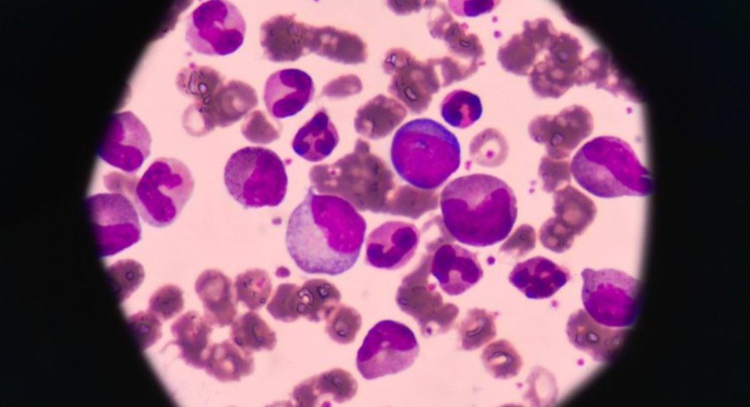 Otkriveni novi spojevi koji ubijaju leukemiju