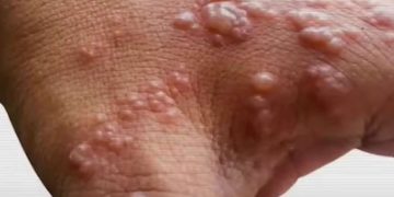 Velika panika među skrivenim homoseksualcima – Majmunske boginje su kao kuga