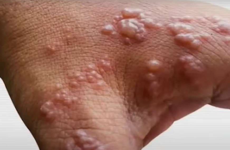 Velika panika među skrivenim homoseksualcima – Majmunske boginje su kao kuga