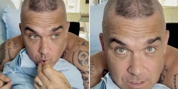 Robbie Williams o gubitku kose: Plaćao sam tretmane po istoj cijeni koliko je kuća moje bake
