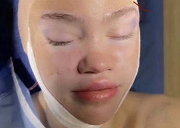 Muskova bivša djevojka objavila fotografiju u zavojima, ranije otkrila da želi “ličiti na vilenjaka”