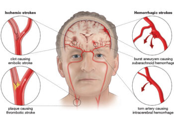 Nova otkrića glazbe o lječenju moždanog udara