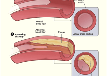 Mnogima se kolesterol normalizira bez lijekova, promjenom životnih navika.