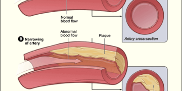 Mnogima se kolesterol normalizira bez lijekova, promjenom životnih navika.
