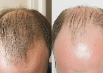 Kako su Turci iznenadili svijet sa presađivanjem kose milijune ljudi?