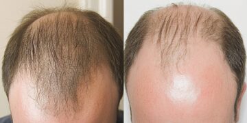 Kako su Turci iznenadili svijet sa presađivanjem kose milijune ljudi?