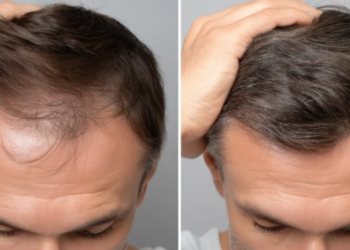 Transplantacija kose postaje sve popularnija: Koliko košta i što treba znati prije zahvata?