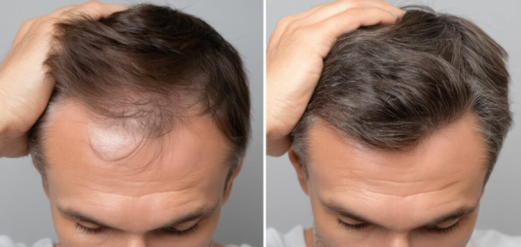 Transplantacija kose postaje sve popularnija: Koliko košta i što treba znati prije zahvata?